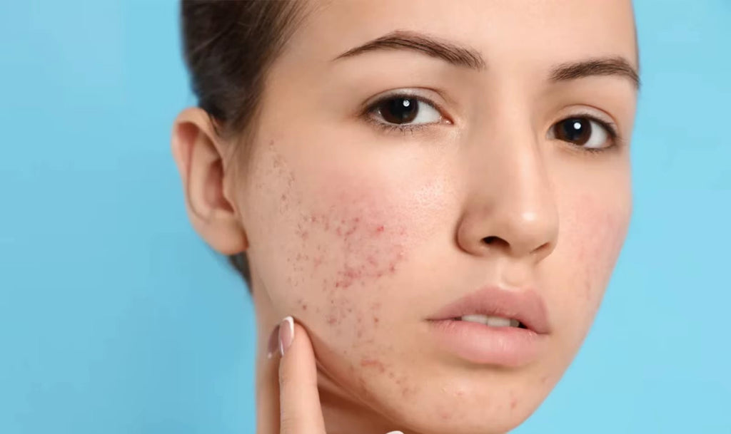 Pimple Acne Treatment Face Cream Nourish Balance Oil Control Refreshing Repairing Pimple Remover Acne Removing Cleansing Cream